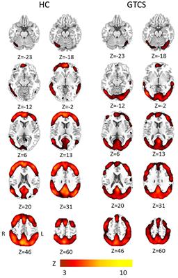 Altered Local Spatiotemporal Consistency of Resting-State BOLD Signals in Patients with Generalized Tonic-Clonic Seizures